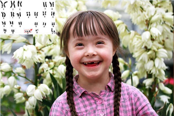 🇯🇵 Đột phá từ Nhật Bản: Có thể loại bỏ hoàn toàn nhiễm sắc thể gây hội chứng Down?