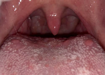 Nổi mụn nhỏ ở cuống lưỡi là dấu hiệu bệnh gì?