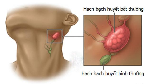 Tại Sao Bị Ung Thư Máu Và Dấu Hiệu Bị Ung Thư Máu? 