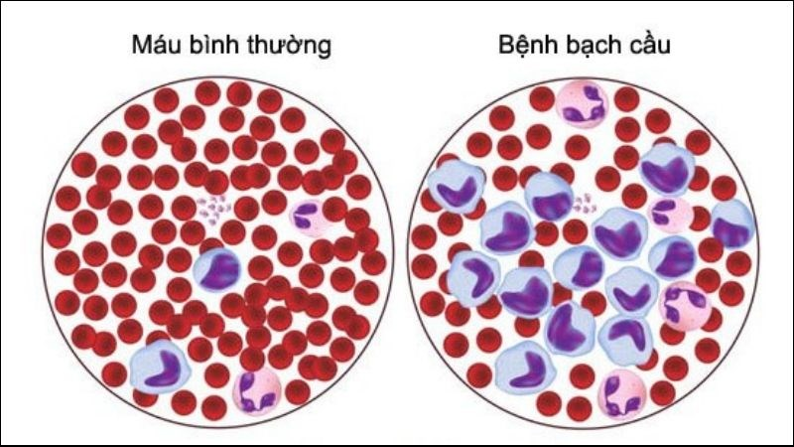 Tại Sao Bị Ung Thư Máu Và Dấu Hiệu Bị Ung Thư Máu? 