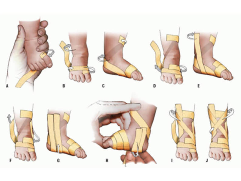 Cách nhận biết sớm bàn chân vẹo trong ở trẻ sơ sinh