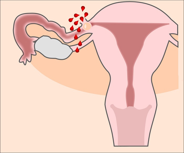 Thai ngoài tử cung có giữ được không?