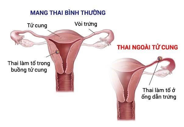 Thai ngoài tử cung có giữ được không?