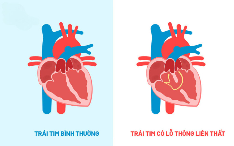 Thông liên thất tim là gì? Nguyên nhân, triệu chứng và cách điều trị