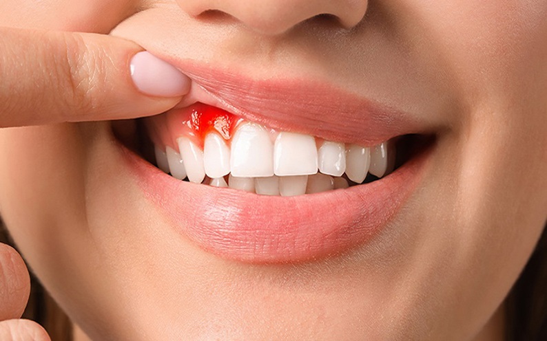 Bệnh răng miệng thường gặp khi mang thai