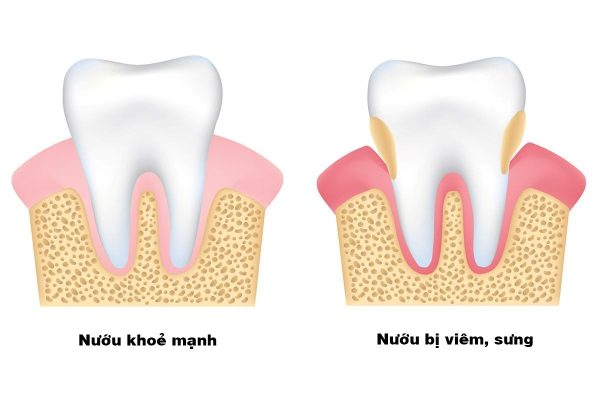 Cách Phân Biệt Giữa Viêm Nha Chu và Viêm Nướu