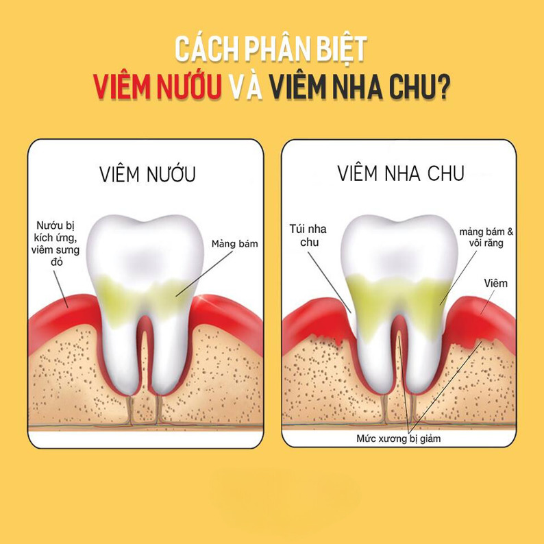 Cách Phân Biệt Giữa Viêm Nha Chu và Viêm Nướu