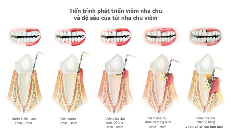 Cách Phân Biệt Giữa Viêm Nha Chu và Viêm Nướu