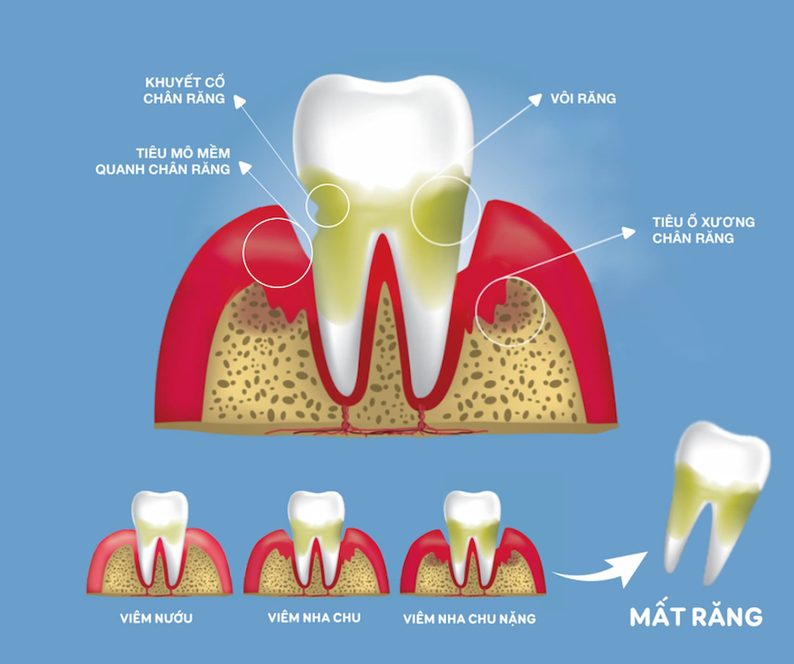 Cách Phân Biệt Giữa Viêm Nha Chu và Viêm Nướu