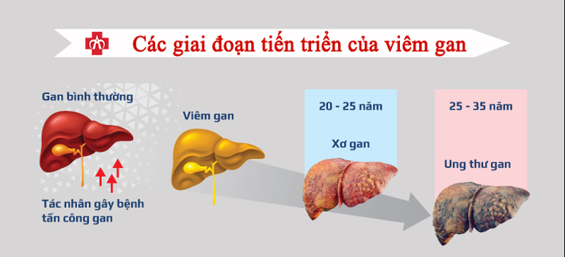 Viêm Gan Siêu Vi: Nguyên Nhân, Triệu Chứng và Phương Pháp Điều Trị