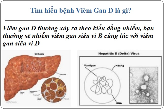 Viêm Gan Siêu Vi: Nguyên Nhân, Triệu Chứng và Phương Pháp Điều Trị