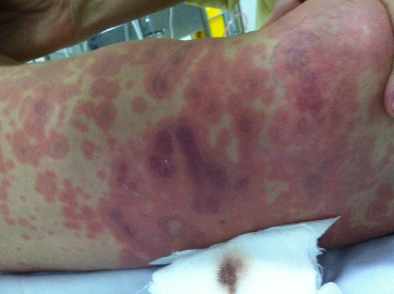 Bệnh Viêm Màng Não Do Não Mô Cầu: Nguyên Nhân, Triệu Chứng Và Cách Phòng Chống