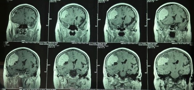 Đau đầu nhiều năm, đi khám phát hiện khối u màng não to hơn quả trứng