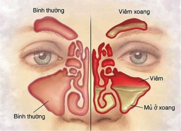 Làm sao để điều trị dứt điểm viêm xoang?