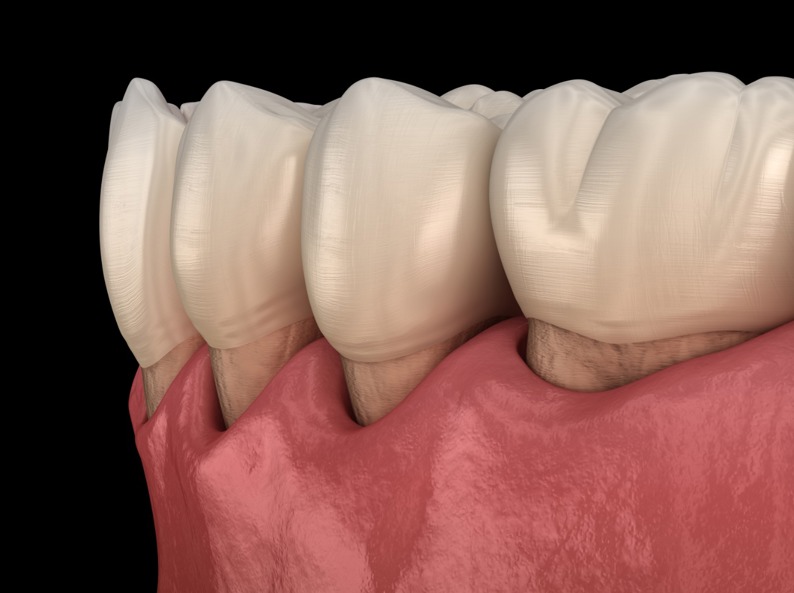 Dấu hiệu của bệnh viêm chân răng có mủ?