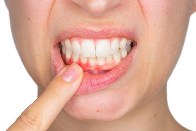 VIÊM NƯỚU – Lý do gây chảy máu thường xuyên khi đánh răng