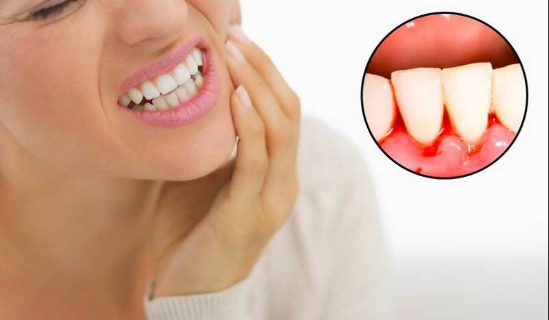 VIÊM NƯỚU – Lý do gây chảy máu thường xuyên khi đánh răng