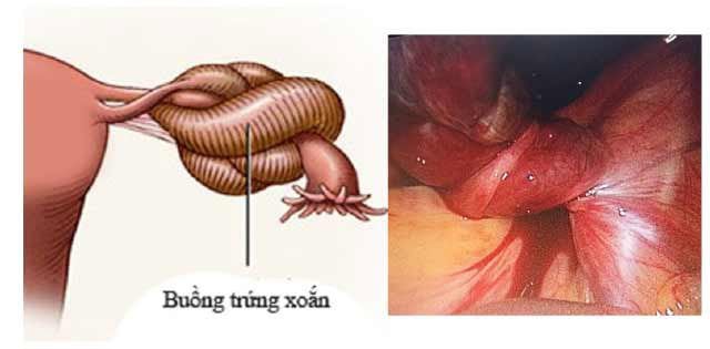 Phát hiện u nang khi mang thai 