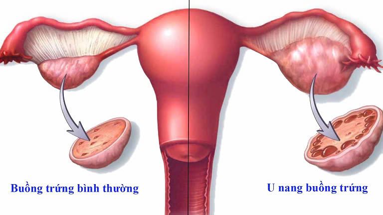 Phát hiện u nang khi mang thai 