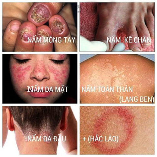 Cách Bảo Vệ Làn Da Trước Các Bệnh Nấm Da Phổ Biến