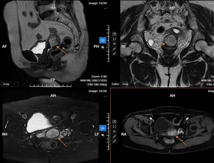 Chụp MRI có gây vô sinh không? 