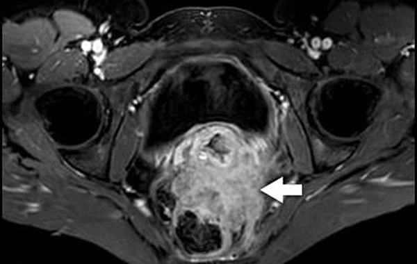 Chụp MRI tử cung phát hiện bệnh gì?