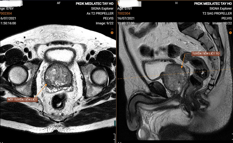 Chụp MRI có gây vô sinh không? 