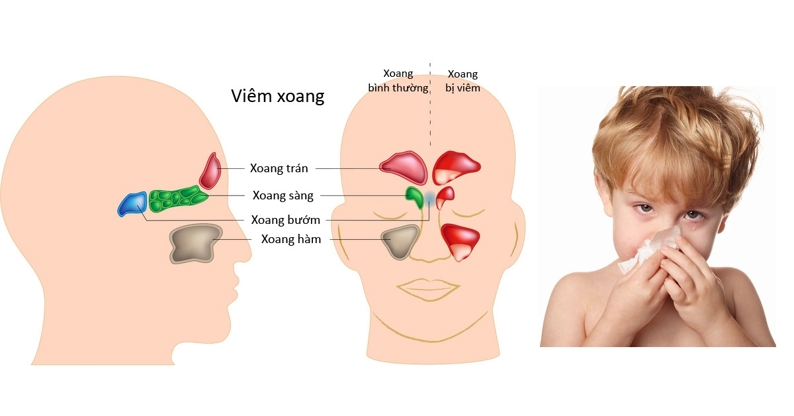 Thời điểm mắc các bệnh giao mùa ở trẻ là tháng mấy?