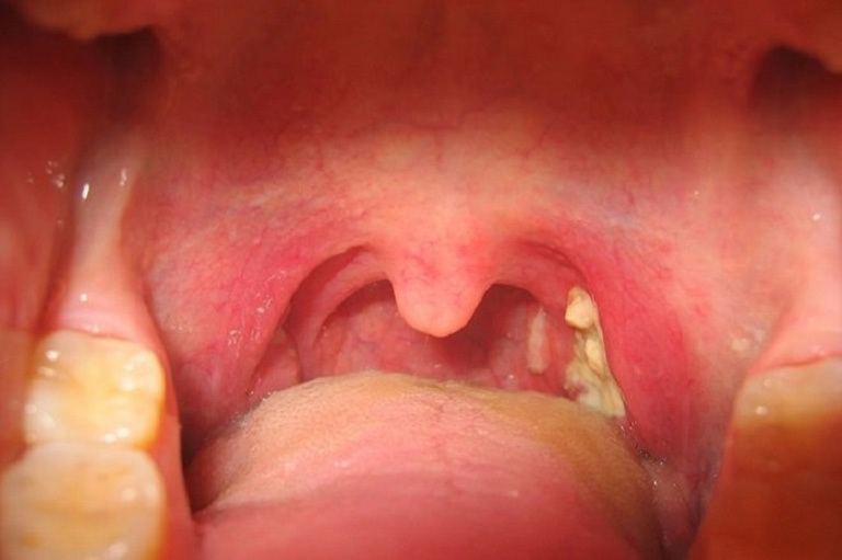 Nổi hạt trắng trong cổ họng là bệnh gì?