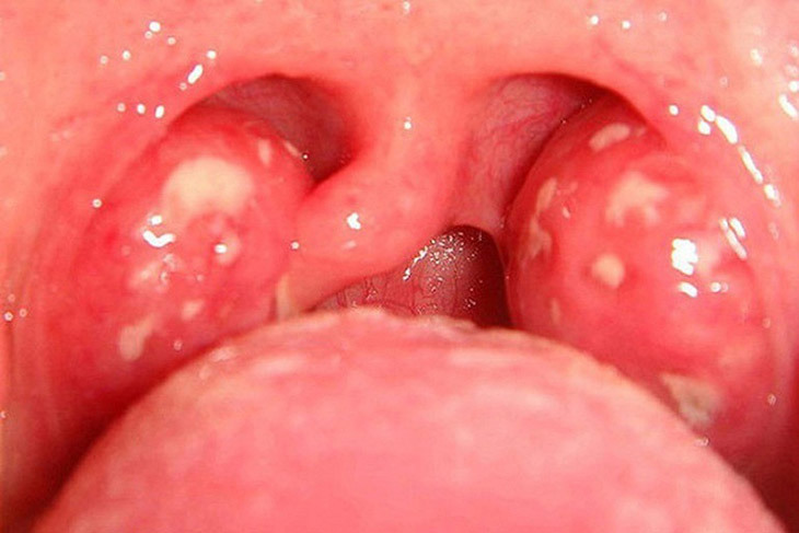 Nổi hạt trắng trong cổ họng là bệnh gì?