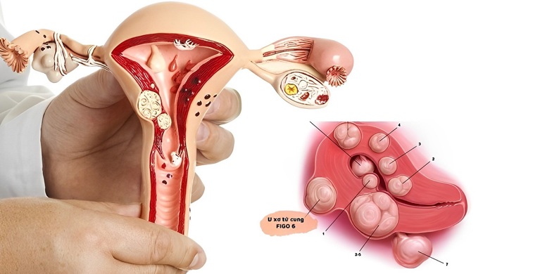 U xơ tử cung - Khi nào nên theo dõi?