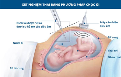 Chọc Ối Là Gì? Tất Tần Tật Những Điều Mẹ Bầu Cần Biết Trước Khi Thực Hiện