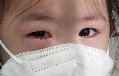 Đau mắt đỏ ở trẻ có cần phải nhập viện?