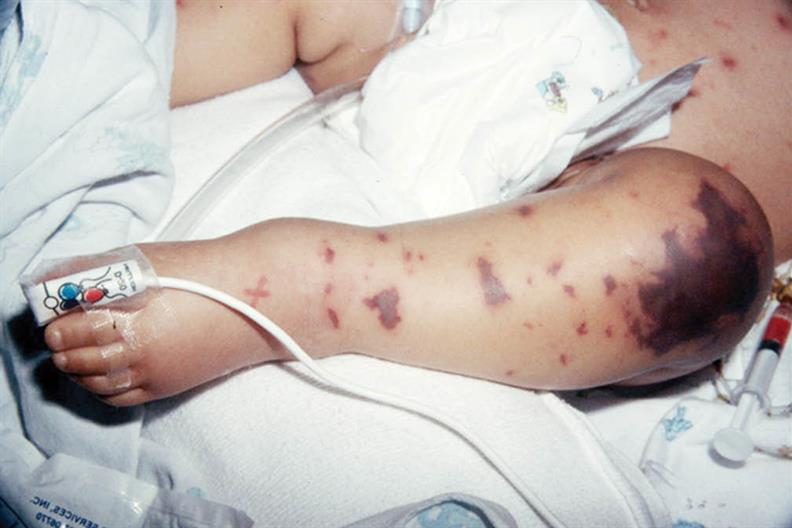 TP.HCM phát cảnh báo khẩn về bệnh viêm màng não do não mô cầu: Nguy hiểm và có thể tử vong chỉ sau vài giờ!