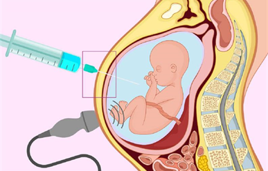 Chọc ối có nguy hiểm không?