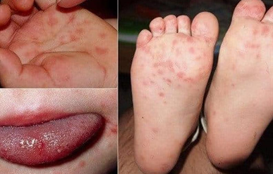 Hình Ảnh Bệnh Tay Chân Miệng Ở Trẻ Em  Cha Mẹ Cần Lưu Ý