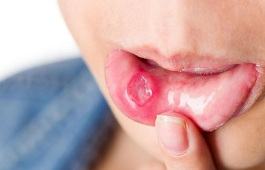 Nguyên nhân nhiệt miệng hay tái phát?