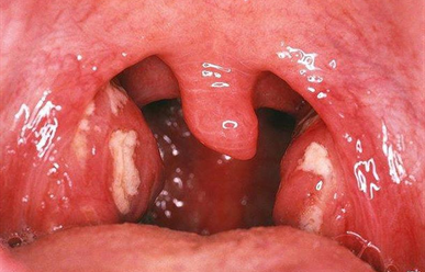 Amidan sưng to, nổi đốm viêm có phải ung thư không?