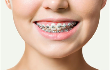 Những trường hợp nào cần niềng răng?
