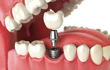 Những điều cần biết khi trồng răng Implant