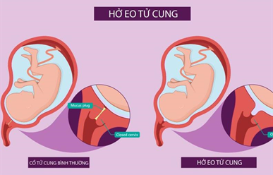 Hở eo tử cung khi mang thai: Dấu hiệu nhận biết, nguyên nhân và cách xử lý an toàn cho mẹ và bé