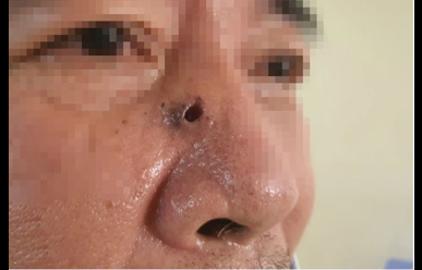 TP. HCM: Lõm mũi, biến dạng mặt vì căn bệnh "hiểm" liên quan đến nắng nóng