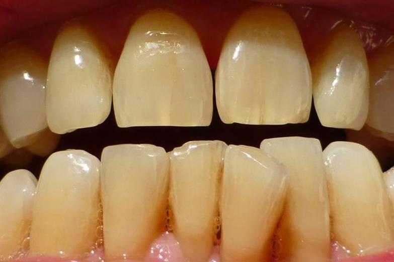 Tại sao răng ố vàng? Khám phá 10 nguyên nhân hàng đầu