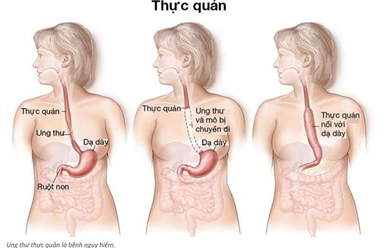 Ung Thư Thực Quản: Hiểu Đúng – Phát Hiện Sớm – Điều Trị Hiệu Quả