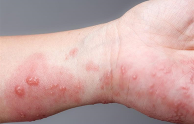 Bệnh Ghẻ nước - nguyên nhân, triệu chứng và cách điều trị dứt điểm