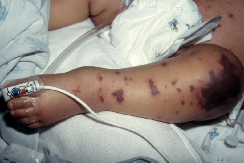 Phân Biệt Dấu Hiệu Não Mô Cầu Và Phát Ban Thông Thường