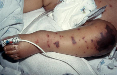 Phân Biệt Dấu Hiệu Não Mô Cầu Và Phát Ban Thông Thường