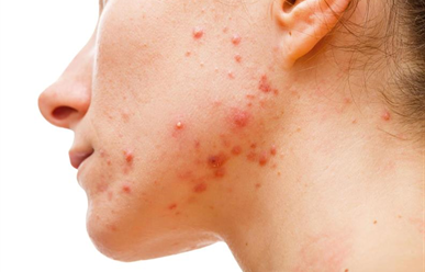 Bác sĩ da liễu mách bạn cách thoát khỏi mụn trứng cá