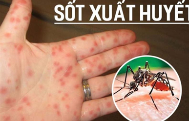 Sốt xuất huyết có lây không?