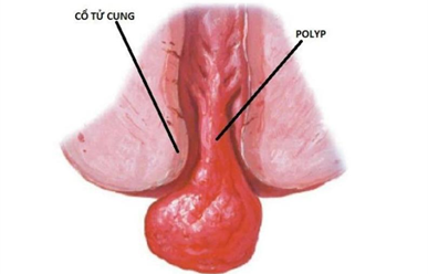 Cắt Polyp bao lâu thì có thể có thai lại?